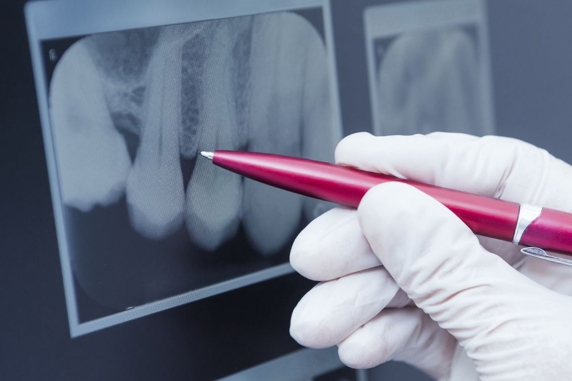 Photo of a pen pointed at a dental x-ray