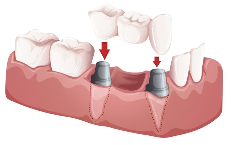 Image of implant-supported dental bridge