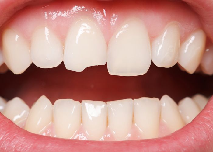 A closeup of a smile with a chipped tooth
