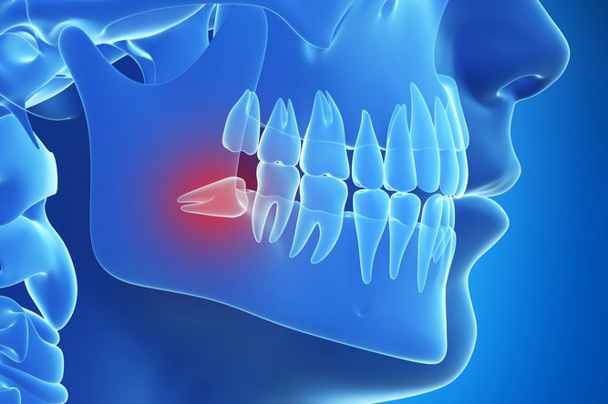 An impacted wisdom tooth