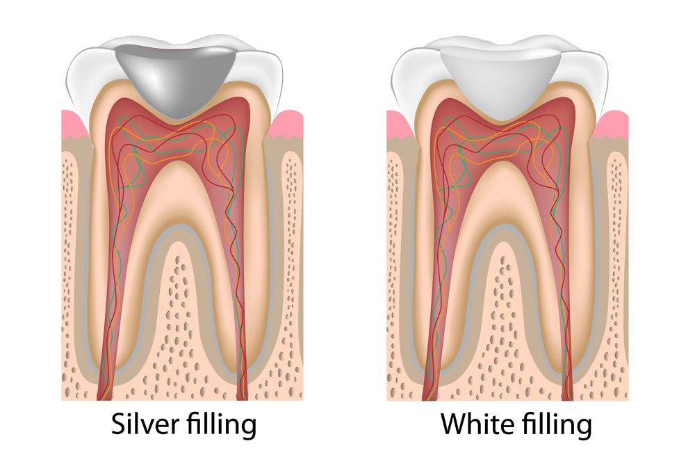 Side-by-side illustration of silver and white fillings
