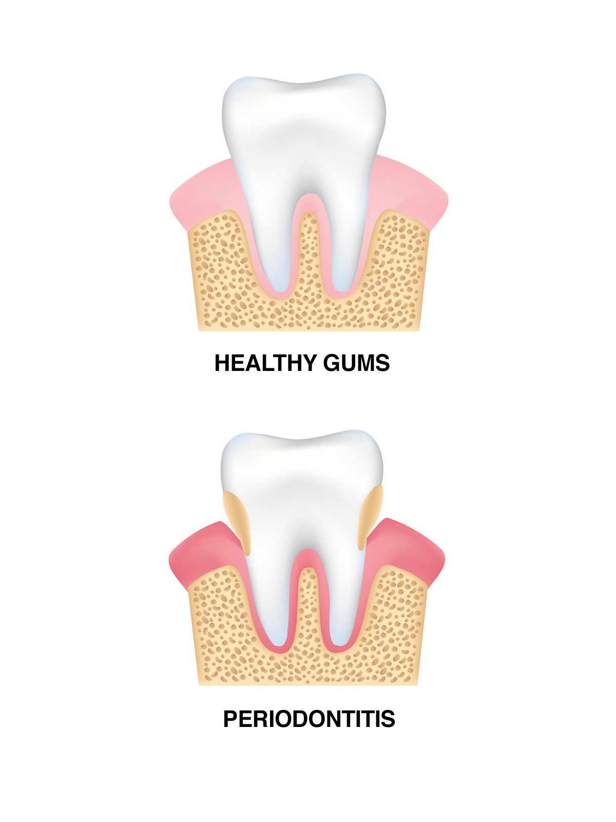 Illustration of healthy gums vs. periodontitis