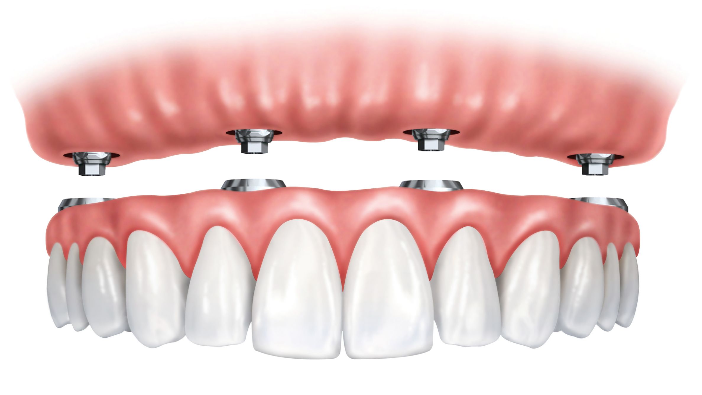 Image of fixed hybrid dental prosthesis