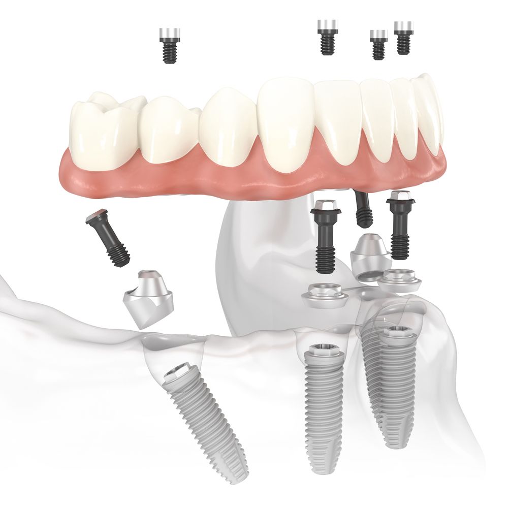 An illustration showing All-on-4 dental implants