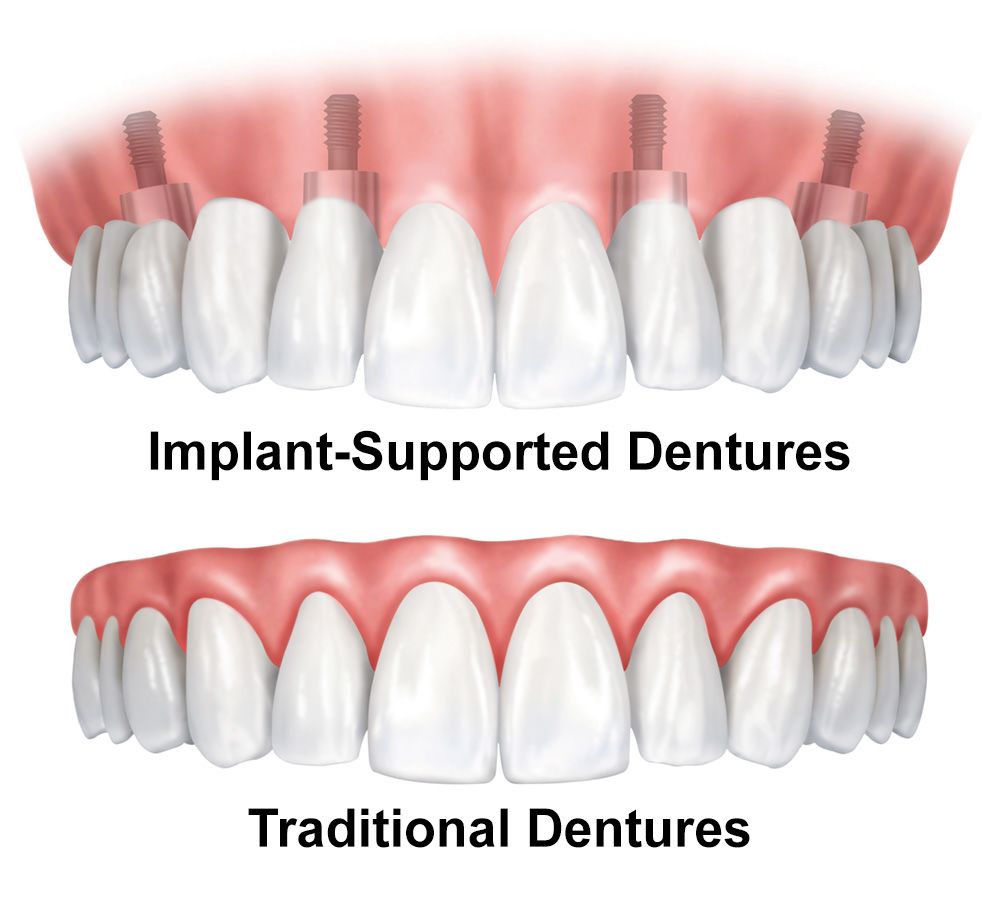 image of traditional dentures and implant-supported dentures