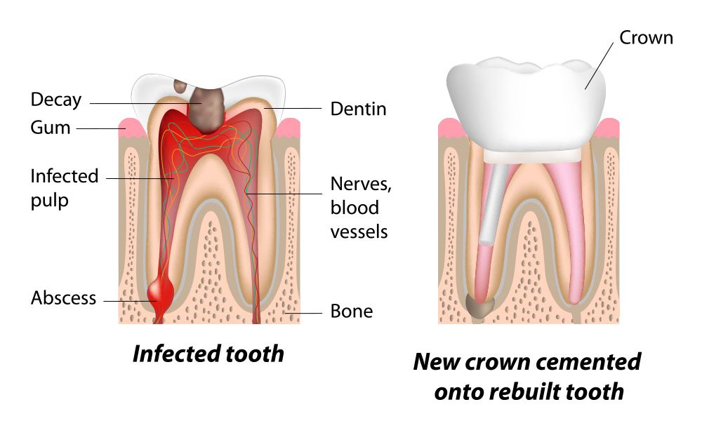 Illustration of root canal therapy.