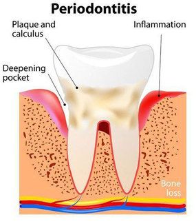 Diagram of periodontitis