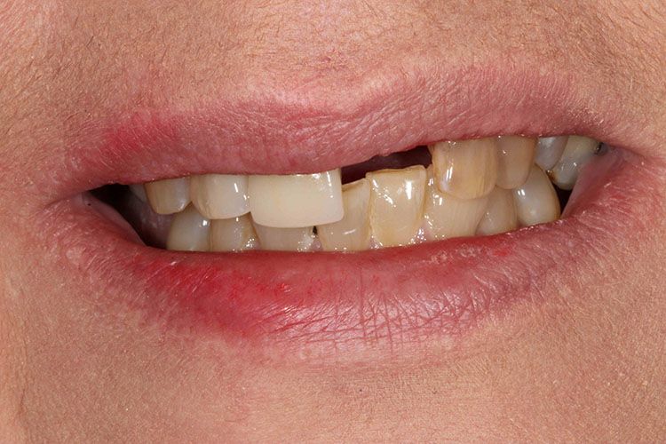 before dental implants