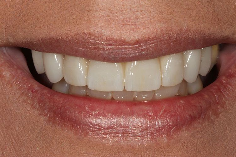 after dental implants