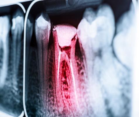 Root canal infection