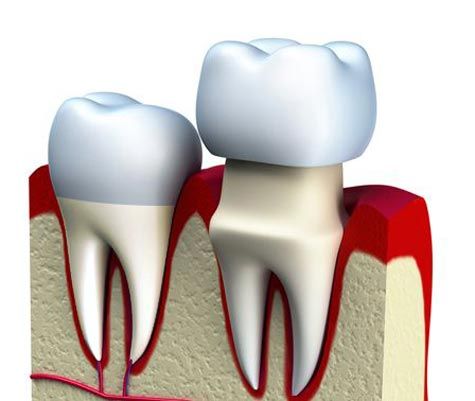 Two dental crowns