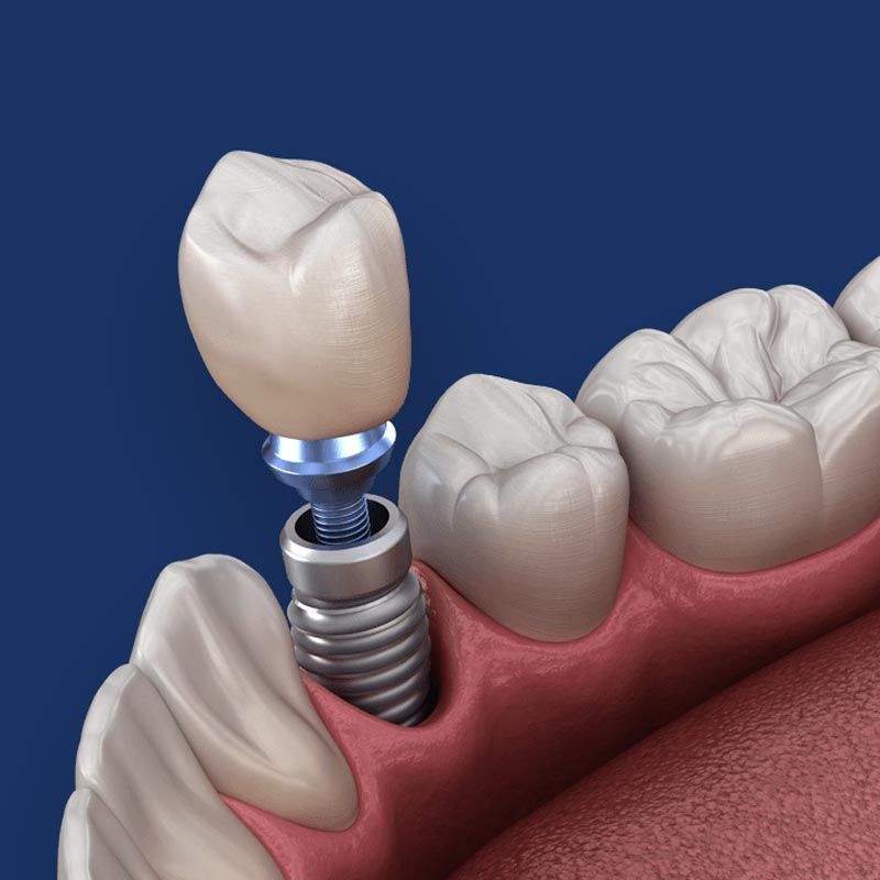 Implant crown