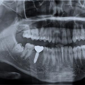 dental x-ray