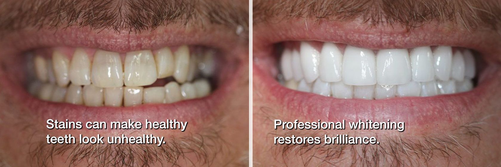 Before and after of a yellowed smile