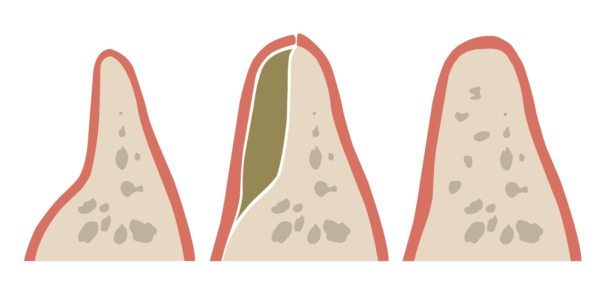 Illustration of a bone graft
