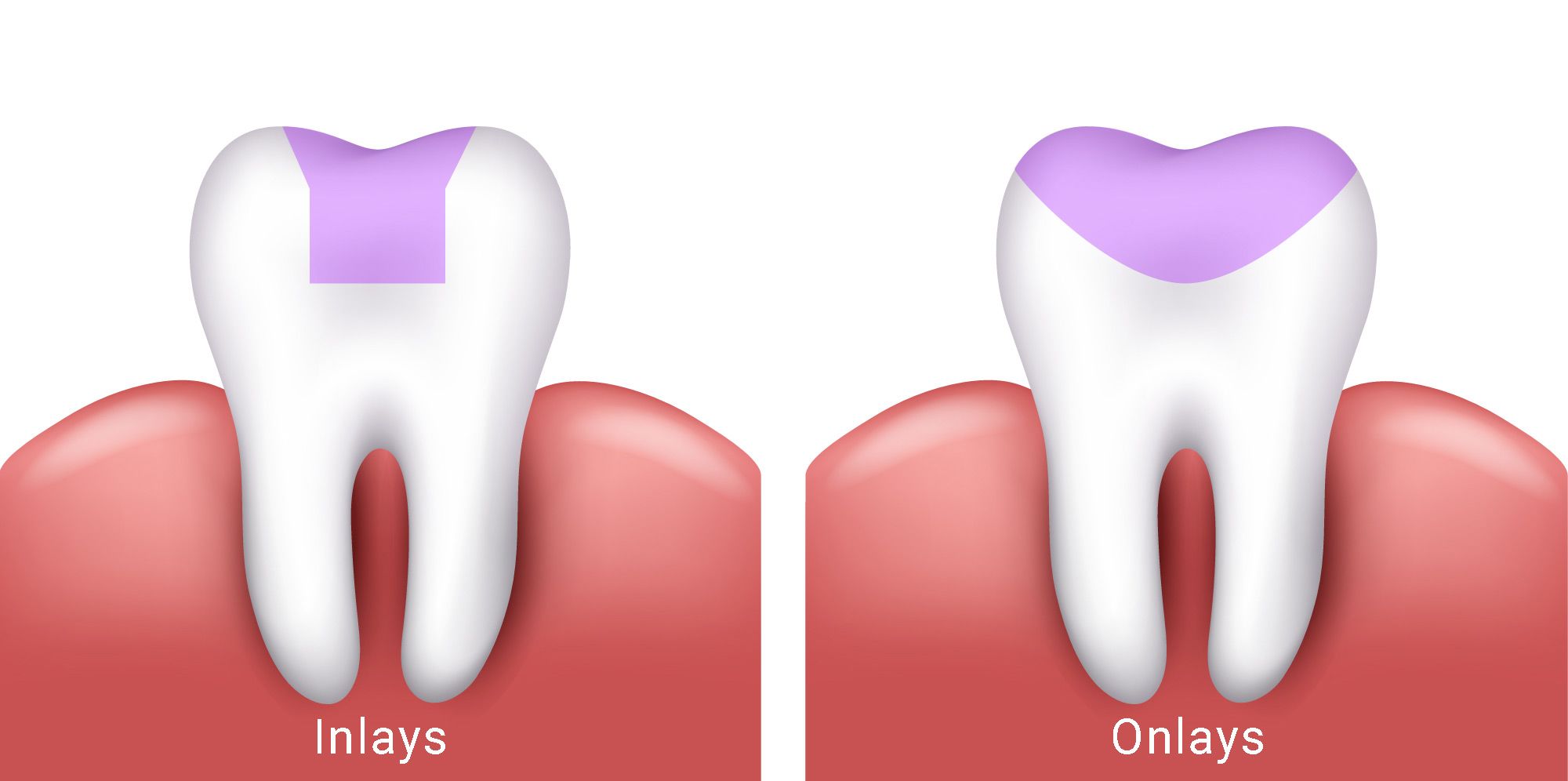 Image of dental inlay and onlay