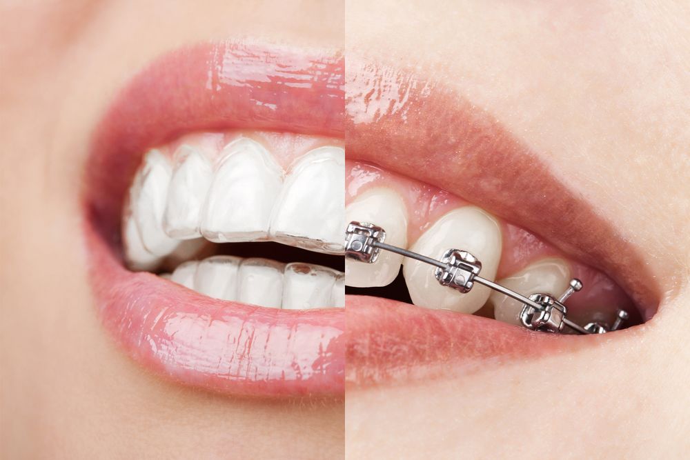 Teeth covered with a clear aligner next to teeth covered with traditional metal braces
