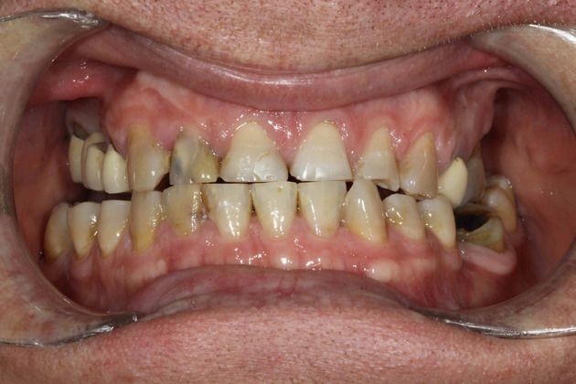 Before full mouth reconstruction