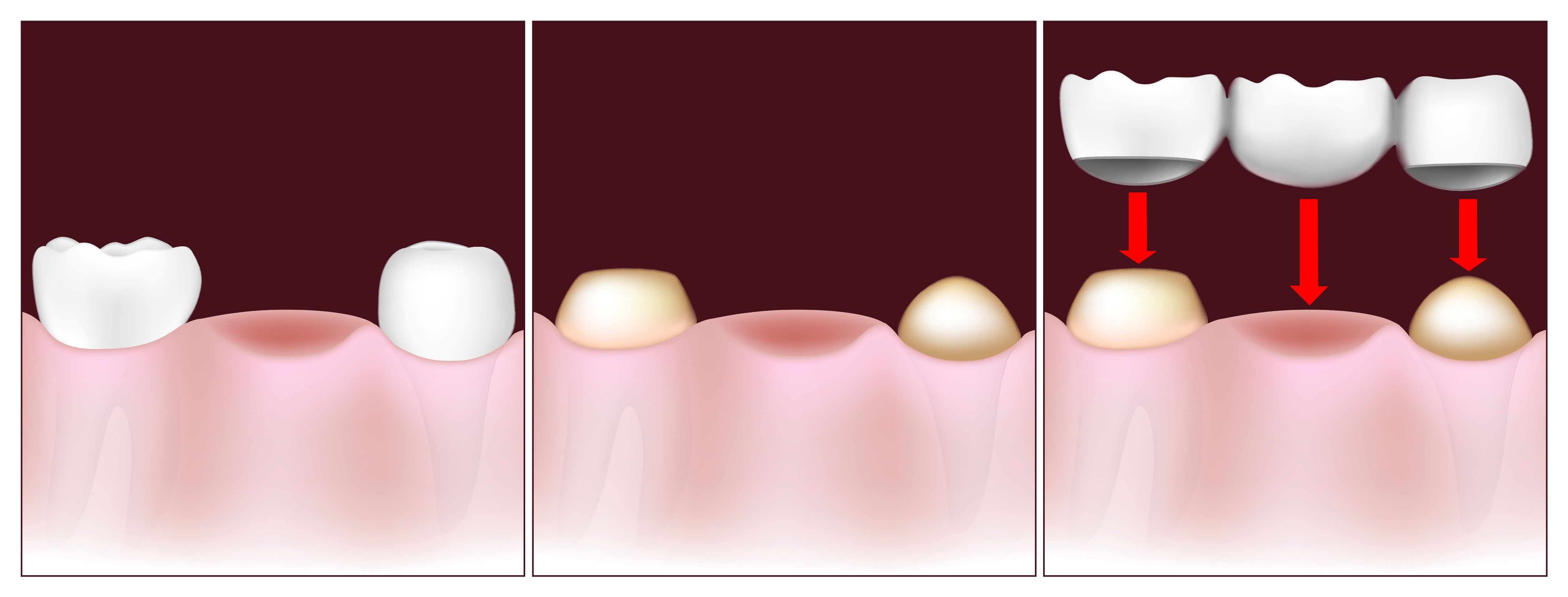 Image of dental bridge